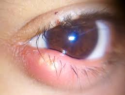 Close-up of lower eyelid tumor