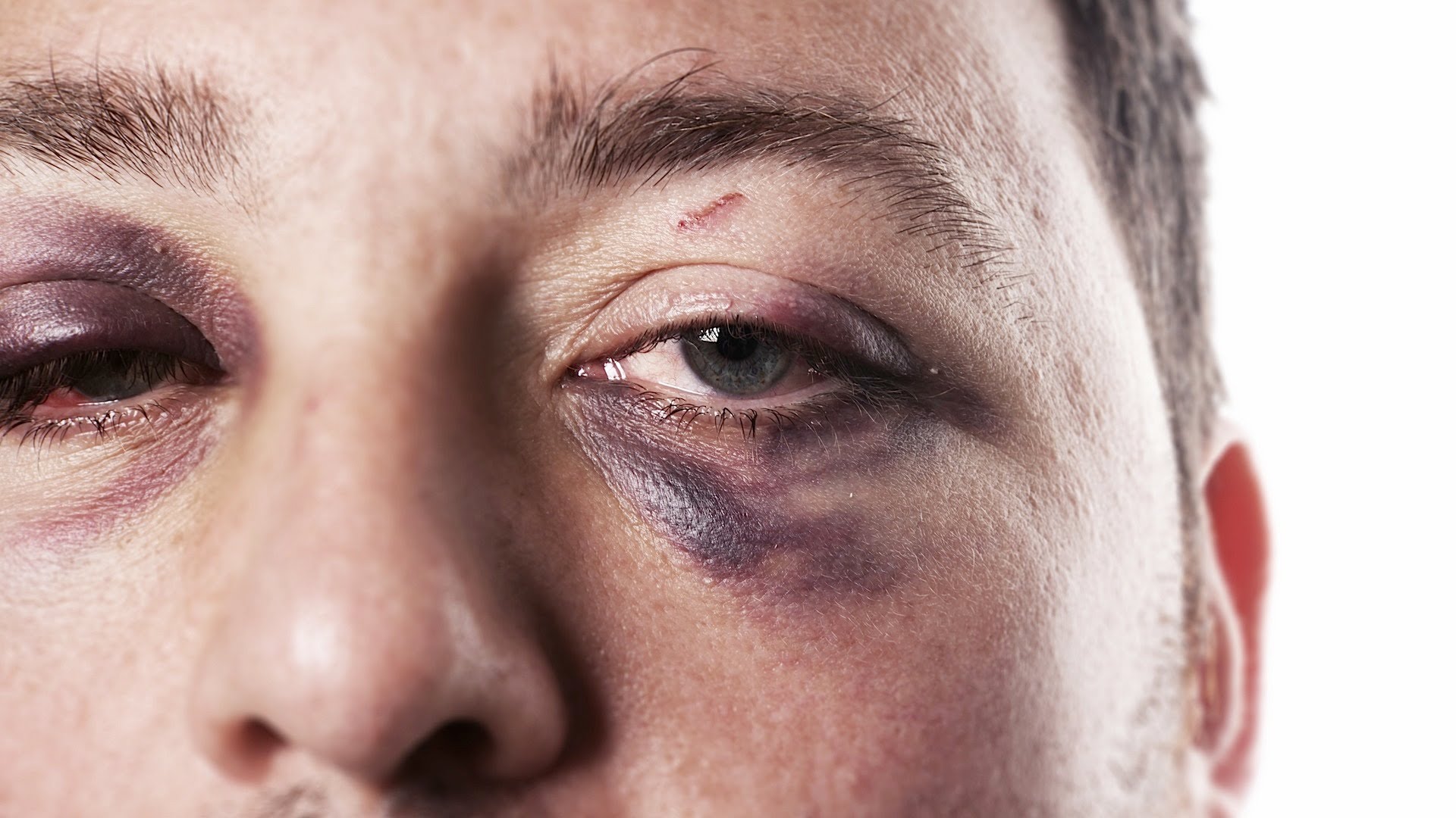 Swollen black eye deals